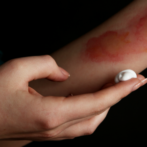 Burn injuries at work