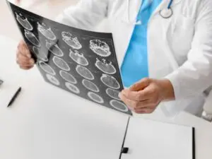 A medical professional in Allentown closely examines brain scans of a traumatic brain injury (TBI) victim, highlighting Munley Law's emphasis on thorough medical documentation for injury claims. Munley Law attorneys use these detailed brain scans, such as MRI or CT images, to build strong cases demonstrating the severity and impact of brain injuries. Victims of traumatic brain injuries in Allentown can rely on Munley Law’s experienced personal injury attorneys for skilled representation. Call 855-866-5529 for a free consultation.