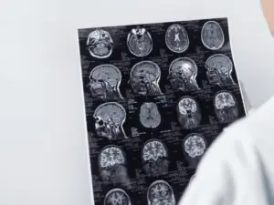 Close-up of a medical expert analyzing comprehensive diagnostic brain scans related to traumatic brain injuries (TBIs) of a Scranton patient.