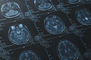 Can medical malpractice cause a stroke