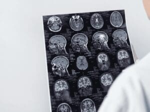 Close-up of a medical expert analyzing comprehensive diagnostic brain scans related to traumatic brain injuries (TBIs). Such careful medical analysis informs the average brain injury settlement amounts by determining necessary treatments and expected recovery. For legal guidance on brain injury settlements, contact Munley Law in Allentown, PA at (855) 866-5529. Medical documentation significantly impacts settlement valuations.