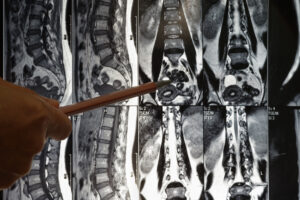 MRI of spinal cord with doctor pointing